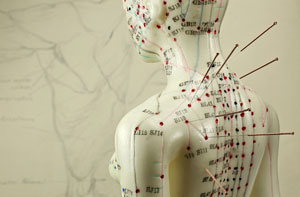 Acupuncture Near Me Kinver