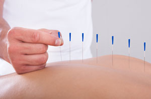 Acupuncture for Pain Relief Byfleet