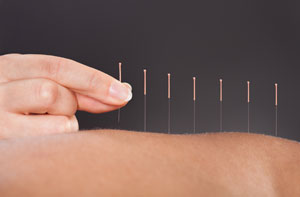 Acupuncture Neath Wales