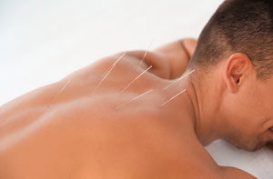 Acupuncture Litherland