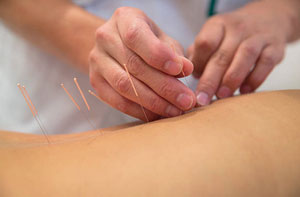 Acupuncture Coppull