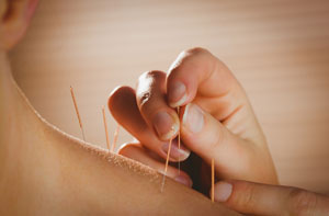 Does Acupuncture Work?